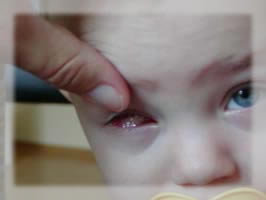 Kind mit Augenprothese